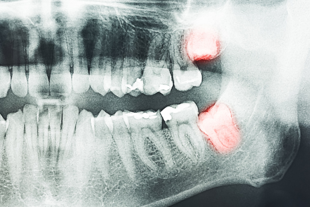 teeth X-ray showing dental problems
